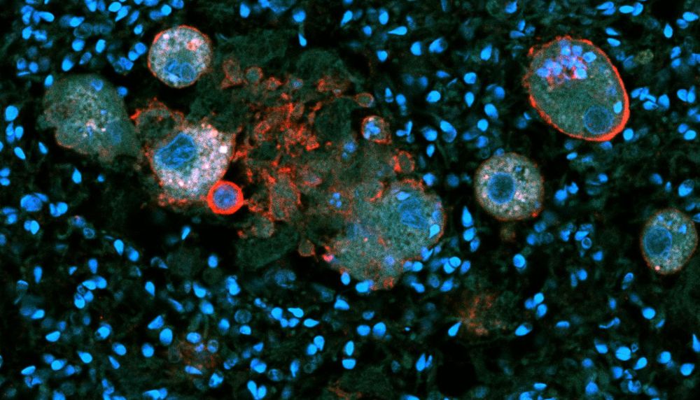 Les cellules sphériques que l'on voit sur cette image sont des leucocytes CD45+. Ces cellules du système immunitaire abondent lorsqu'il y a inflammation. La cellule CD45+ située en haut à droite a phagocyté 11 spermatozoïdes.