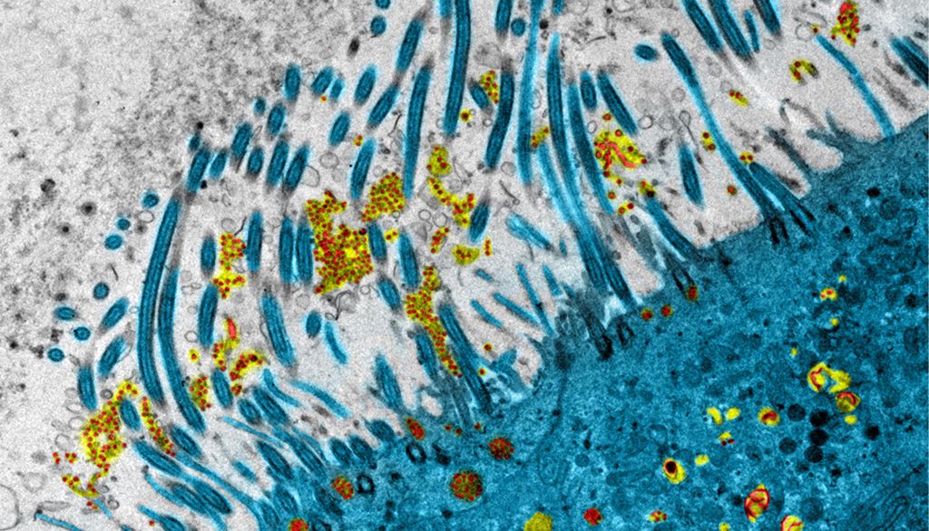 Épithélium nasal infecté par le SARS-COV-2