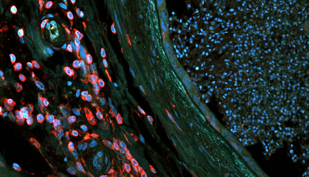 Cette coupe transversale de l'épididyme d'un sujet vasectomisé montre, à droite, en bleu, un grand nombre de spermatozoïdes. À gauche, en rouge, on observe des leucocytes CD45+ en abondance. Ces cellules du système immunitaire sont rares dans l'épididyme des sujets non vasectomisés.