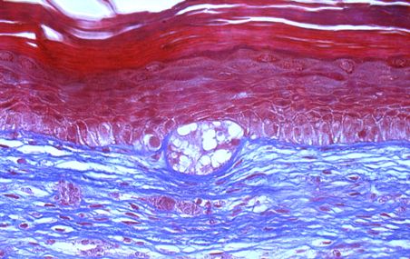 <p>Le modèle de peau humaine du Laboratoire d'organogénèse expérimentale est formé de couches bien distinctes dans lesquelles on trouve des cellules (en rouge), du collagène (en bleu) et des vaisseaux sanguins. La masse circulaire au centre de l'image est formée de cellules cancéreuses.</p>