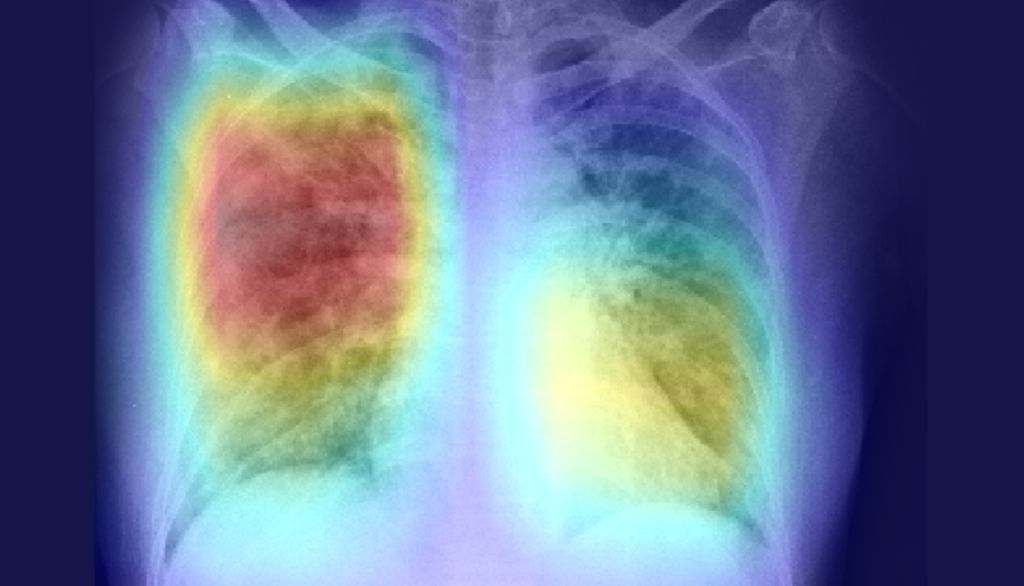 <p>Simon Duchesne et ses collaborateurs croient que les radiographies pulmonaires contiennent des informations qui peuvent nous renseigner sur la façon dont évoluera la COVID-19 chez un patient.</p>