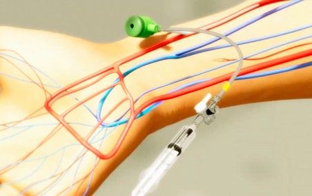 L'utilisation de l'artère radiale pour les interventions coronariennes est associée à un taux de mortalité plus faible pour les patients en infarctus, elle entraîne moins d'inconfort et de saignements et elle réduit la durée et les coûts d'hospitalisation. De plus, l'augmentation des radiations par rayons X associée à cette technique serait trop faible pour avoir des effets négatifs sur la santé des patients.