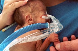 <p>Les problèmes de santé dont sont souvent victimes les grands prématurés nuisent à leur alimentation, ce qui accroît les risques de malnutrition, notamment de carence en DHA.</p>