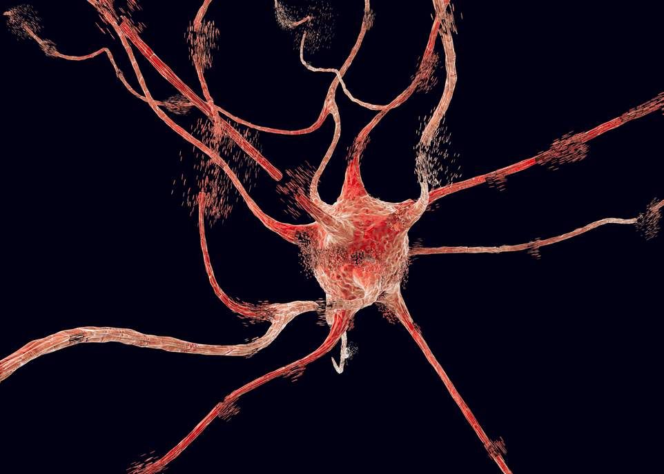 Les agrégats de la protéine alpha-synucléique forment des fibrilles dans les neurones des patients atteints de parkinson. Ces fibrilles toxiques activent la PARP-1, une protéine qui enclenche le processus de mort cellulaire.