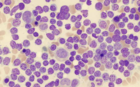 La leucémie lymphoïde chronique se caractérise par la prolifération d'un type de globules blancs, les lymphocytes, en mauve sur la photo.