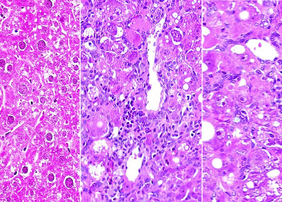 L'image de gauche montre un foie de souris tyrosinémique traitée avec le médicament NTBC. Les deux autres images montrent des lésions hépatiques qui apparaissent quatre semaines et huit semaines après l'arrêt du traitement. De tels changements sont détectés dès la première semaine avec certains miARN.