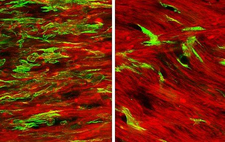 Chez les souris normales, à gauche, les cellules microgliales (en vert) s'agglomèrent près de la myéline (en rouge). Chez les souris dépourvues de récepteur CX3CR1, à droite, les cellules microgliales sont moins abondantes. L'élimination des débris de myéline ne peut se dérouler normalement.