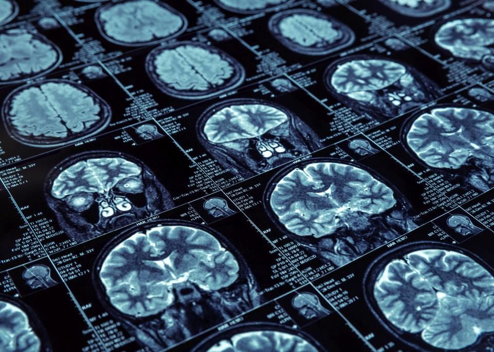 <p>Les symptômes postcommotionnels persistent pendant trois mois ou plus chez environ 15% des victimes de traumatismes crâniens légers. Un outil pronostique efficace aiderait les médecins à identifier ces patients afin de leur assurer un suivi plus étroit.</p>