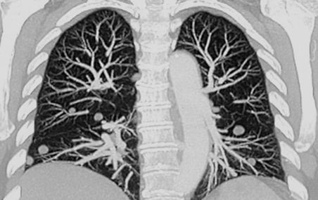 <p>Cette image obtenue par tomodensitométrie révèle la présence de nombreux nodules pulmonaires. La difficulté consiste à savoir s'ils deviendront des tumeurs malignes.</p>