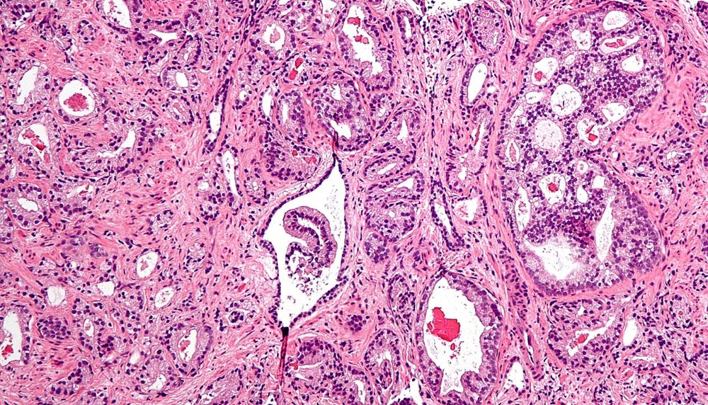 <p>Cette image prise au microscope montre des cellules cancéreuses dans une coupe de la prostate.</p>