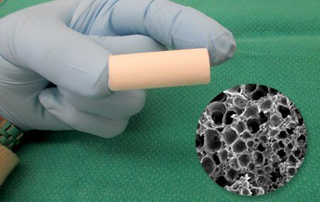 <p>La matrice de PLCL, à laquelle les chercheurs ont ajouté du collagène et de l'hydroxyapatite, offre un milieu accueillant pour les cellules qui produisent le tissu osseux. En médaillon, une coupe transversale de cette matrice en révèle la structure poreuse, semblable à celle de l'os. </p>