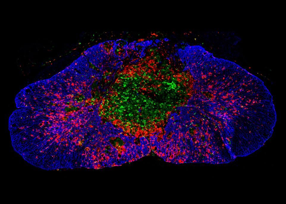Cette image montre la moelle épinière d'une souris 14 jours après une lésion. La zone endommagée, au centre, est infiltrée par des macrophages et des neutrophiles (en vert). Les cellules microgliales (en rouge tomate) forment une cicatrice bien définie autour de la blessure. La cicatrice formée par les astrocytes (en bleu) commence à s'organiser autour de la première, mais il faut attendre au 35e jour avant qu'elle soit complètement formée.