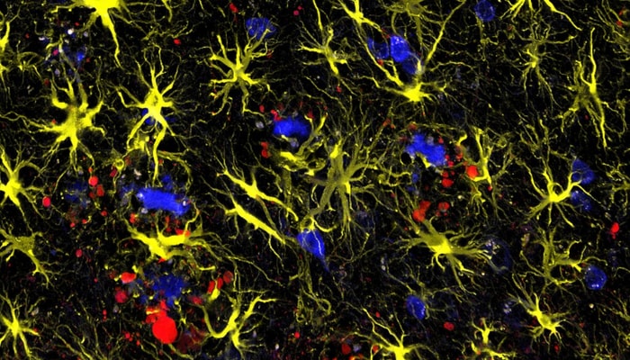 Cette image du cerveau d'une souris atteinte d'alzheimer montre des plaques amyloïdes, en bleu, des neurones atteints, en rouge, et des astrocytes, en jaune. La présence de plaques amyloïdes s'impose de plus en plus comme le seul et unique critère diagnostique de l'alzheimer, malgré les nombreuses observations qui ne soutiennent pas l'hypothèse de l'accumulation de protéines amyloïdes comme cause centrale de cette maladie.