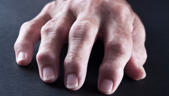 La polyarthrite rhumatoïde est une maladie auto-immune qui entraîne une inflammation et de la douleur dans plusieurs articulations du corps. Elle survient lorsque des cellules du système immunitaire s'attaquent, sans que l'on sache pourquoi, à des articulations saines.