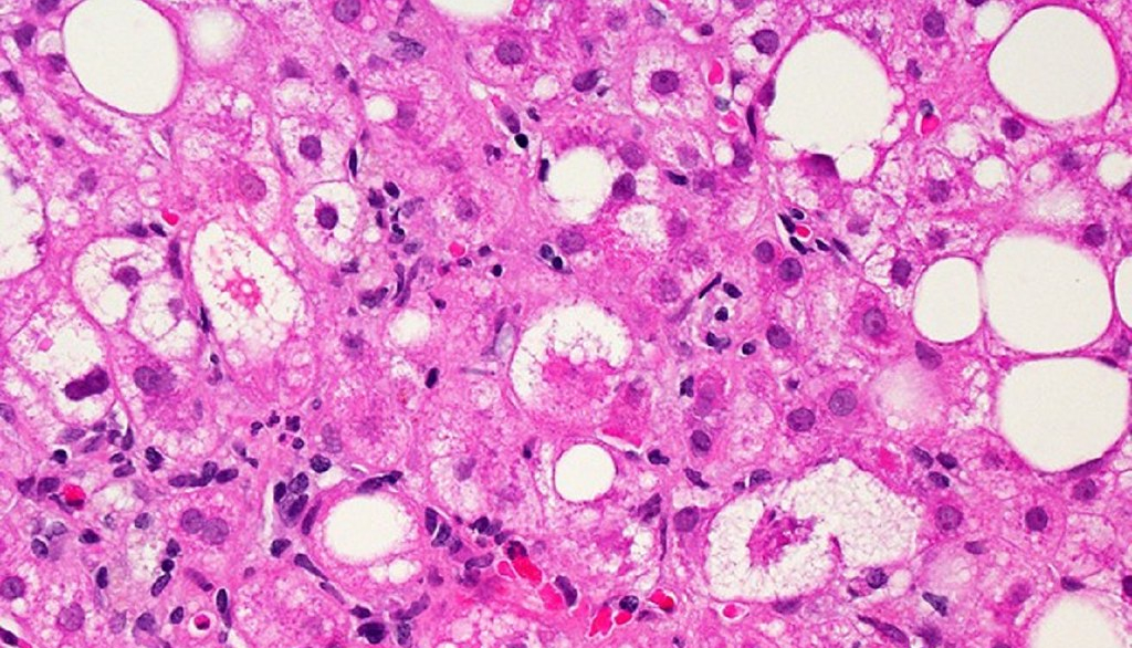 Les cercles blancs que l'on voit sur cette image prise au microscope sont des gouttelettes de lipides qui s'accumulent dans les cellules hépatiques de personnes atteintes de la maladie du foie gras. Chez les gens qui souffrent de cette maladie, les lipides représentent plus de 5% du poids du foie.