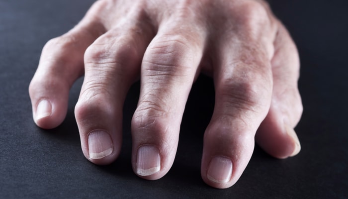 La polyarthrite rhumatoïde est une maladie auto-immune qui entraîne une inflammation et de la douleur dans plusieurs articulations du corps. Elle survient lorsque des cellules du système immunitaire s'attaquent, sans que l'on sache pourquoi, à des articulations saines.