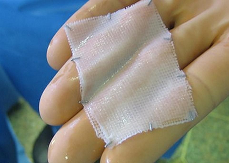 Le substitut cutané développé par les chercheurs de l'Université Laval est produit à partir d'un petit échantillon de peau saine du patient. Ces cellules cutanées sont mises en culture pendant quelques semaines et le résultat est un feuillet formé de deux couches, le derme et l'épiderme, qui peut être implanté sur le grand brûlé.