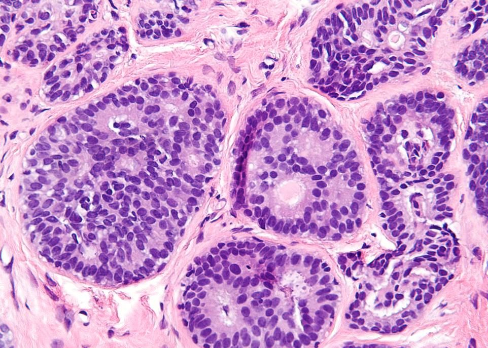 Cette image montre une situation où il y a augmentation du nombre de cellules anormales dans les canaux mammaires. Bien qu'il ne s'agisse pas d'un cancer, cette condition est associée à une augmentation du risque de cancer. Des marqueurs génomiques pourraient aider à repérer de façon précoce les cas qui risquent d'évoluer vers le cancer du sein.