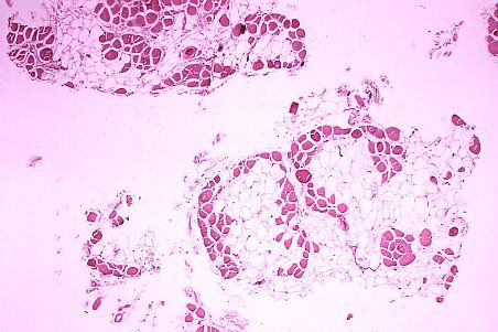 <p>Chez les patients atteints de dystrophie musculaire de Duchenne, les fibres musculaires (mauves) s'atrophient et sont remplacées par des cellules adipeuses (translucides). L'ostéoprotégérine pourrait prévenir ce type de dommages.</p>