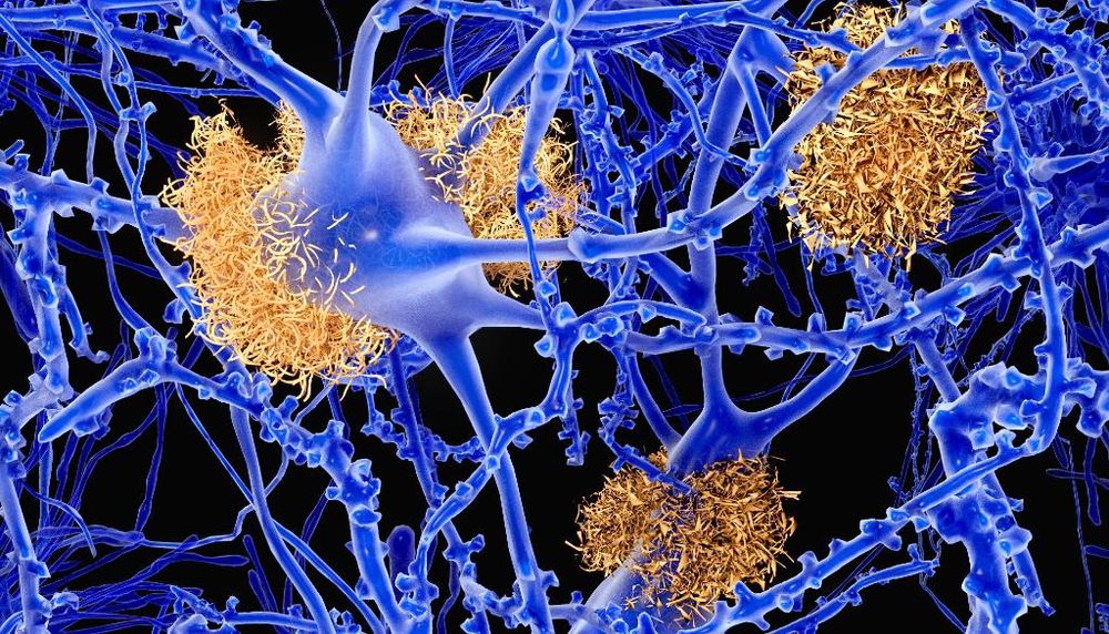 La formation de plaques amyloïdes conduit à la mort des neurones chez les personnes atteintes d'alzheimer. Le gène islandais ralentit la formation de ces peptides toxiques.