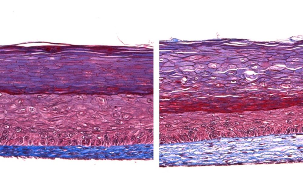 À gauche, une coupe transversale du modèle de peau psoriasique montrant une hyperprolifération et une différenciation anormale des cellules de l'épiderme (la couche du centre). La photo de droite montre que ces problèmes sont atténués lorsqu'un oméga-3 est ajouté au milieu de culture.